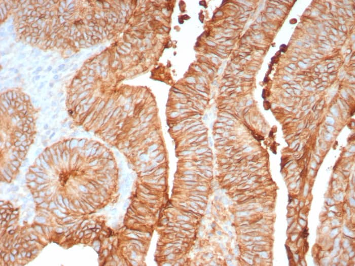 Formalin-fixed, paraffin-embedded human colon stained with Cadherin-17 antibody (CDH17/8158R]) - Azide and BSA Free. Inset: PBS instead of primary antibody; secondary only negative control.