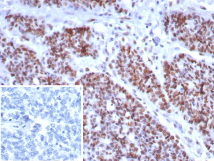 Formalin-fixed, paraffin-embedded human small intestine stained with MSH6 antibody (rMSH6/8337) - Azide and BSA Free. Inset: PBS instead of primary antibody; secondary only negative control.