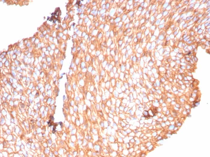 Immunohistochemistry-Paraffin: Uroplakin Ib Antibody (UPK1B/9258R) - Azide and BSA Free [NBP3-24164] - Formalin-fixed, paraffin-embedded human bladder carcinoma stained with Uroplakin Ib Antibody (UPK1B/9258R). HIER: Tris/EDTA, pH9.0, 45min. 2°C: HRP-polymer, 30min. DAB, 5min.