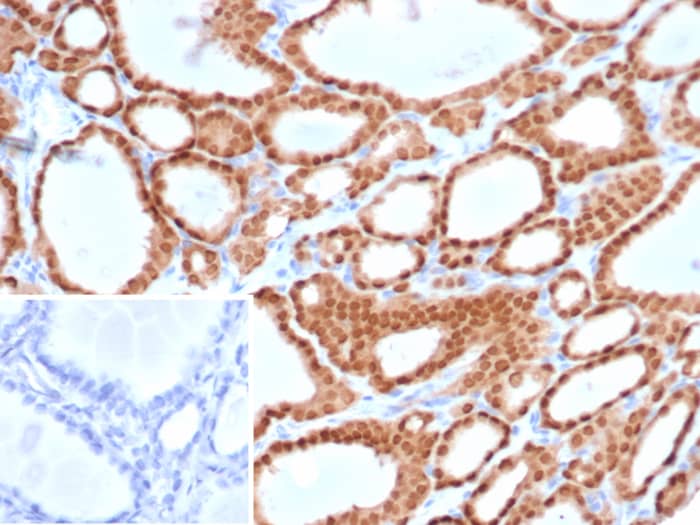 Formalin-fixed, paraffin-embedded human thyroid stained with PAX8 antibody (PAX8/6848R) - Azide and BSA Free. HIER: Tris/EDTA, pH9.0, 45min. Secondary: HRP-polymer, 30min. DAB, 5min.