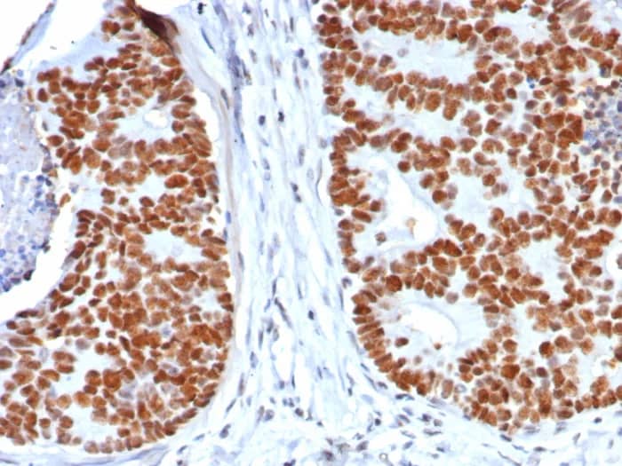 Immunohistochemistry-Paraffin: p53 Antibody (rTP53/8063) - Azide and BSA Free [NBP3-24174] - Formalin-fixed, paraffin-embedded human colon carcinoma stained with p53 Antibody (rTP53/8063). HIER: Tris/EDTA, pH9.0, 45min. 2°C: HRP-polymer, 30min. DAB, 5min.