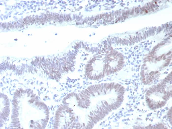 Immunohistochemistry-Paraffin: p53 Antibody (rTP53/8993) - Azide and BSA Free [NBP3-24175] - Formalin-fixed, paraffin-embedded human colon carcinoma stained with p53 Antibody (rTP53/8993). HIER: Tris/EDTA, pH9.0, 45min. 2°C: HRP-polymer, 30min. DAB, 5min.