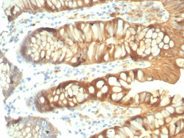 Immunohistochemistry-Paraffin: Galectin-3 Antibody (rLGALS3/7286) - Azide and BSA Free [NBP3-24178] - Formalin-fixed, paraffin-embedded human colon stained with Galectin-3 Antibody (rLGALS3/7286). HIER: Tris/EDTA, pH9.0, 45min. 2°C: HRP-polymer, 30min. DAB, 5min.