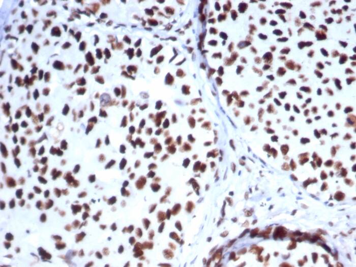 Formalin-fixed, paraffin-embedded human breast carcinoma stained with HspA1B antibody (HSPA1B/7625) - Azide and BSA Free. HIER: Tris/EDTA, pH9.0, 45min. Secondary: HRP-polymer, 30min. DAB, 5min.