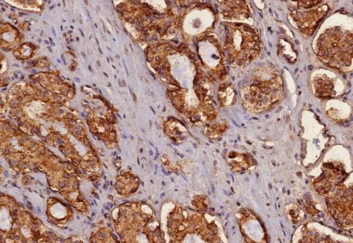 Immunohistochemistry-Paraffin: Cytokeratin, pan Antibody (MonoPoly/4999R) - Azide and BSA Free [NBP3-24196] - Formalin-fixed, paraffin-embedded human prostate carcinoma stained with Cytokeratin, pan Antibody (MonoPoly/4999R)