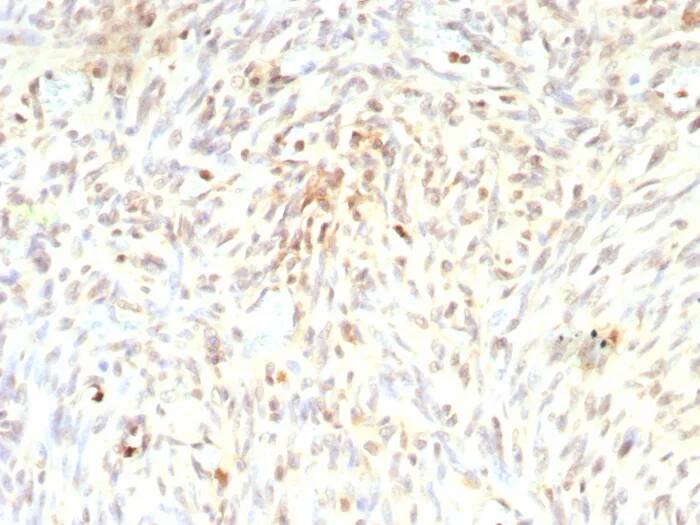 Immunohistochemistry-Paraffin: MDM2/HDM2 Antibody (rMDM2/9214) - Azide and BSA Free [NBP3-24198] - Formalin-fixed, paraffin-embedded human liposarcoma stained with MDM2/HDM2 Antibody (rMDM2/9214). HIER: Tris/EDTA, pH9.0, 45min. 2°C: HRP-polymer, 30min. DAB, 5min.