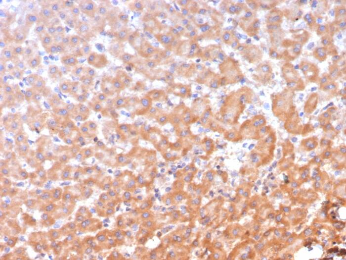 Formalin-fixed, paraffin-embedded human hepatocellular carcinoma stained with ALDH1L1 antibody (ALDH1L1/7958) - Azide and BSA Free. HIER: Tris/EDTA, pH9.0, 45min. Secondary: HRP-polymer, 30min. DAB, 5min.