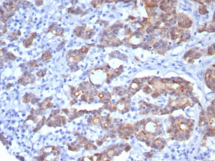 Formalin-fixed, paraffin-embedded human colon adenocarcinoma stained with Villin 1 antibody (rVIL1/8336) - Azide and BSA Free. HIER: Tris/EDTA, pH9.0, 45min. Secondary: HRP-polymer, 30min. DAB, 5min.