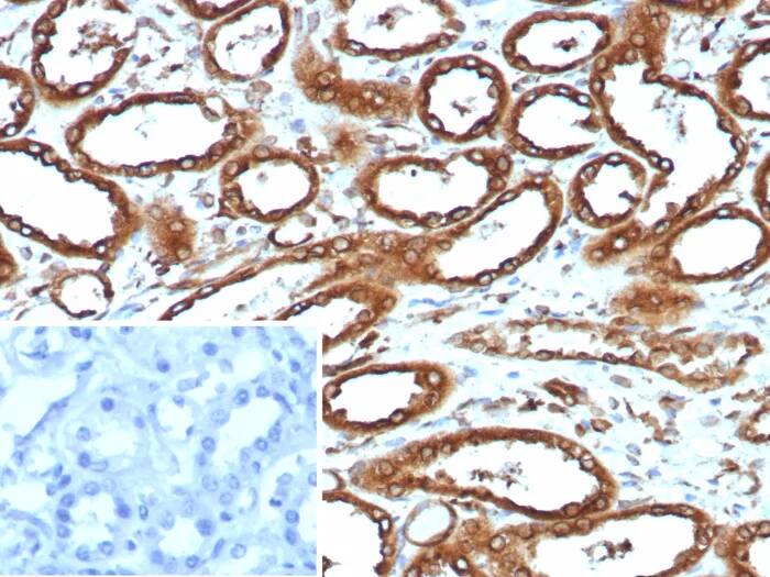 Immunohistochemistry-Paraffin: Calnexin Antibody (CANX/9147R) - Azide and BSA Free [NBP3-24216] - Formalin-fixed, paraffin-embedded human renal cell carcinoma stained with Calnexin Antibody (CANX/9147R). HIER: Tris/EDTA, pH9.0, 45min. 2°C: HRP-polymer, 30min. DAB, 5min.