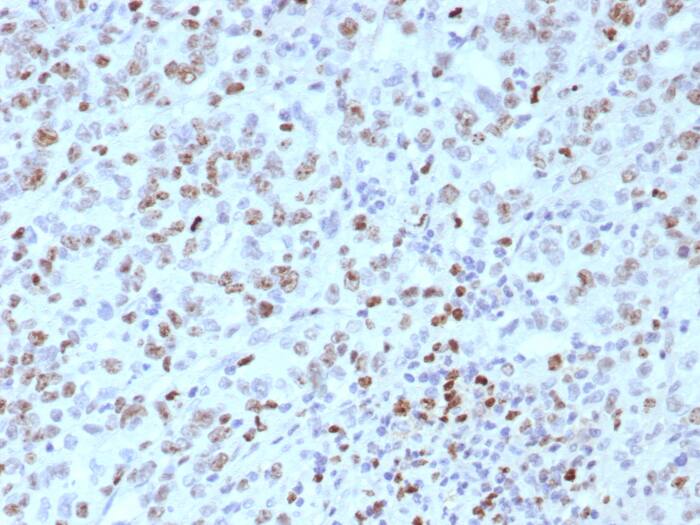 Formalin-fixed, paraffin-embedded human Lynch disease colon stained with MLH1 antibody (rMLH1/8630) - Azide and BSA Free. HIER: Tris/EDTA, pH9.0, 45min. Secondary: HRP-polymer, 30min. DAB, 5min.