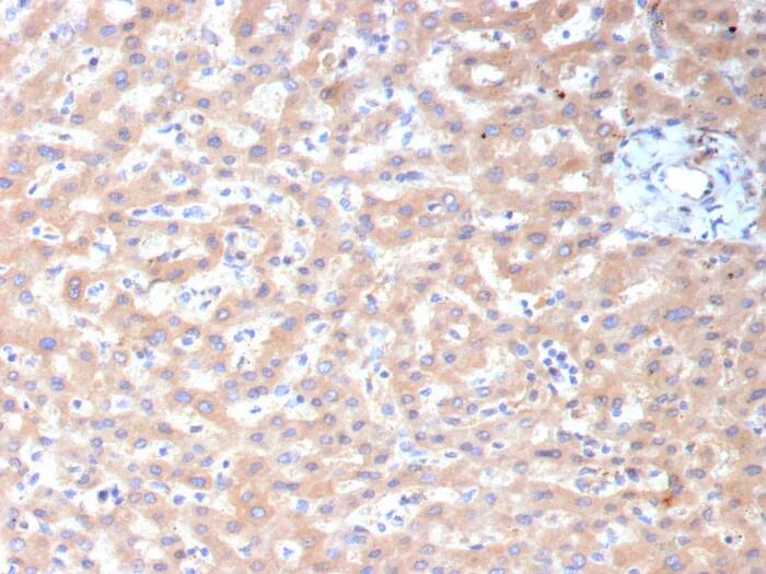 Immunohistochemistry-Paraffin: ALDH1L1 Antibody (ALDH1L1/7959) - Azide and BSA Free [NBP3-24222] - Formalin-fixed, paraffin-embedded human hepatocellular carcinoma stained with ALDH1L1 Antibody (ALDH1L1/7959). HIER: Tris/EDTA, pH9.0, 45min. 2°C: HRP-polymer, 30min. DAB, 5min.