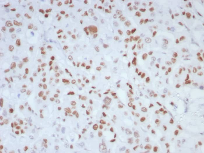 Formalin-fixed, paraffin-embedded human colon stained with MLH1 antibody (MLH1/8855R) - Azide and BSA Free. HIER: Tris/EDTA, pH9.0, 45min. Secondary: HRP-polymer, 30min. DAB, 5min.