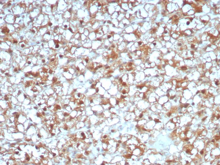 Formalin-fixed, paraffin-embedded human renal cell carcinoma stained with ALDH1L1 antibody (ALDH1L1/7969) - Azide and BSA Free. HIER: Tris/EDTA, pH9.0, 45min. Secondary: HRP-polymer, 30min. DAB, 5min.