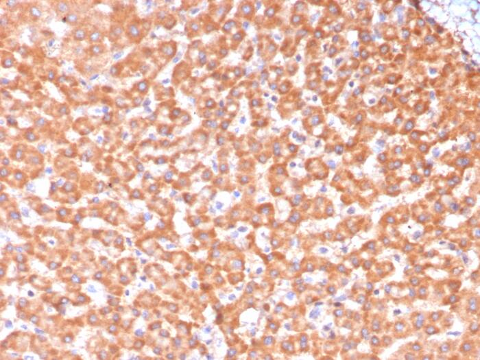 Formalin-fixed, paraffin-embedded human hepatocellular carcinoma stained with ALDH1L1 antibody (ALDH1L1/7969) - Azide and BSA Free. HIER: Tris/EDTA, pH9.0, 45min. Secondary: HRP-polymer, 30min. DAB, 5min.