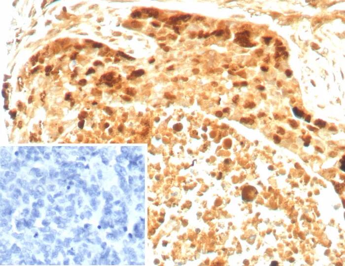 Immunohistochemistry-Paraffin: Survivin Antibody (BIRC5/8936R) - Azide and BSA Free [NBP3-24238] - Formalin-fixed, paraffin-embedded human ovarian cancer stained with Survivin Antibody (BIRC5/8936R). Inset: PBS instead of primary antibody; secondary only negative control.
