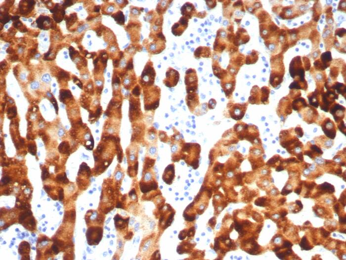 Formalin-fixed, paraffin-embedded human HBV-infected liver stained with HBsAg antibody (HBsAg/7556R) - Azide and BSA Free. HIER: Tris/EDTA, pH9.0, 45min. Secondary: HRP-polymer, 30min. DAB, 5min.