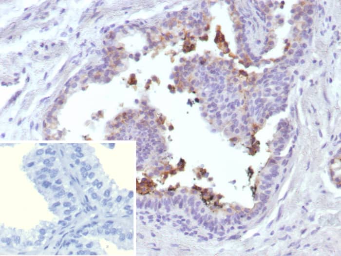 Formalin-fixed, paraffin-embedded human prostate cancer stained with MRP4/ABCC4 antibody (ABCC4/9018) - Azide and BSA Free. Inset: PBS instead of primary antibody; secondary only negative control.