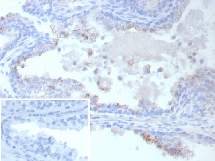 Formalin-fixed, paraffin-embedded human prostate cancer stained with MRP4/ABCC4 antibody (ABCC4/9019) - Azide and BSA Free. Inset: PBS instead of primary antibody; secondary only negative control.