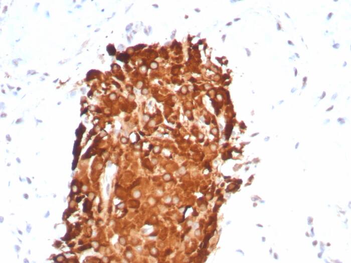 IHC analysis of formalin-fixed, paraffin-embedded human testicular carcinoma. Stained with Inhibin alpha antibody (INHA/8872R) - Azide and BSA Free at 2ug/ml in PBS for 30min RT. HIER: Tris/EDTA, pH9.0, 45min. Secondary: HRP-polymer, 30min. DAB, 5min.