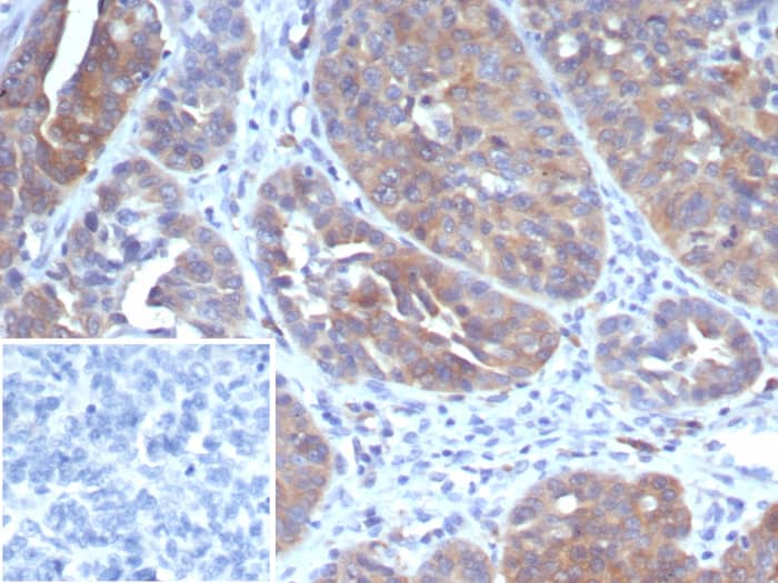 Formalin-fixed, paraffin-embedded human ovarian cancer stained with GCLM antibody (GCLM/4069) - Azide and BSA Free. Inset: PBS instead of primary antibody; secondary only negative control.