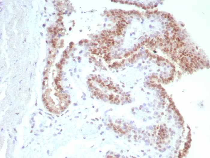 Formalin-fixed, paraffin-embedded human prostate carcinoma stained with Androgen R/NR3C4 antibody (rDHTR/8818) - Azide and BSA Free. HIER: Tris/EDTA, pH9.0, 45min. Secondary: HRP-polymer, 30min. DAB, 5min.