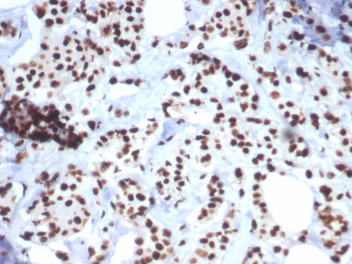 Formalin-fixed, paraffin-embedded human breast carcinoma stained with HspA1B antibody (HSPA1B/7627) - Azide and BSA Free. HIER: Tris/EDTA, pH9.0, 45min. Secondary: HRP-polymer, 30min. DAB, 5min.