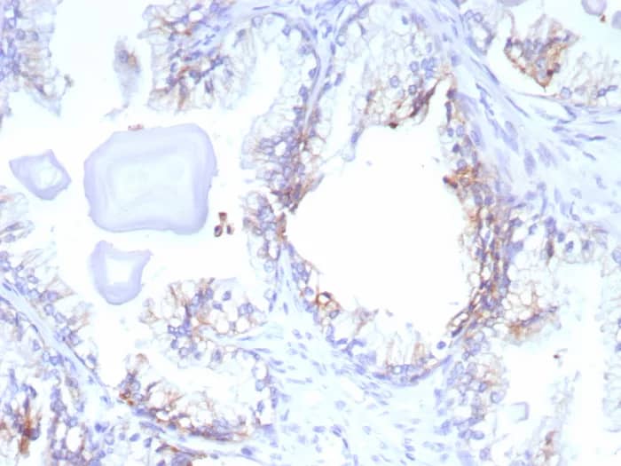Immunohistochemistry-Paraffin: MRP4/ABCC4 Antibody (ABCC4/9179) - Azide and BSA Free [NBP3-24281] - Formalin-fixed, paraffin-embedded human prostate cancer stained with MRP4/ABCC4 Antibody (ABCC4/9179). HIER: Tris/EDTA, pH9.0, 45min. 2°C: HRP-polymer, 30min. DAB, 5min.