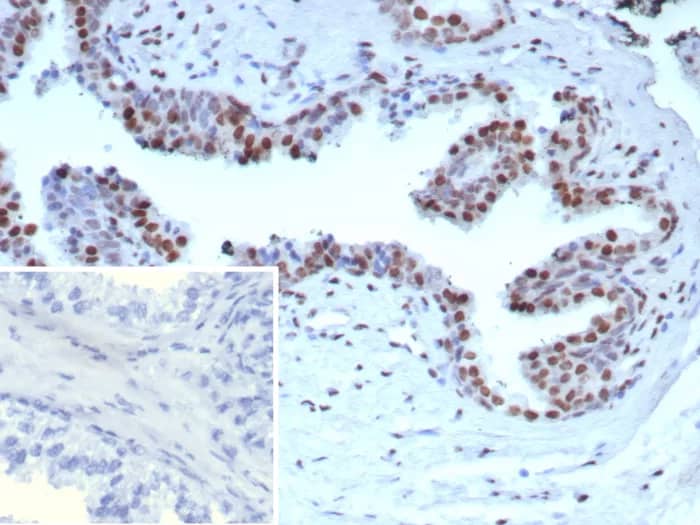Immunohistochemistry-Paraffin: Androgen R/NR3C4 Antibody (DHTR/9119R) - Azide and BSA Free [NBP3-24284] - Formalin-fixed, paraffin-embedded human prostate carcinoma stained with Androgen R/NR3C4 Antibody (DHTR/9119R). HIER: Tris/EDTA, pH9.0, 95°C/45min. 2°CAb: HRP-Poly:30min. DAB:5min.