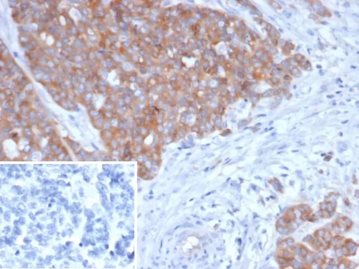 Immunohistochemistry-Paraffin: BRAF35 Antibody (BRAF/1323) - Azide and BSA Free [NBP3-24308] - Formalin-fixed, paraffin-embedded human ovarian cancer stained with BRAF35 Antibody (BRAF/1323). Inset: PBS instead of primary antibody; secondary only negative control.