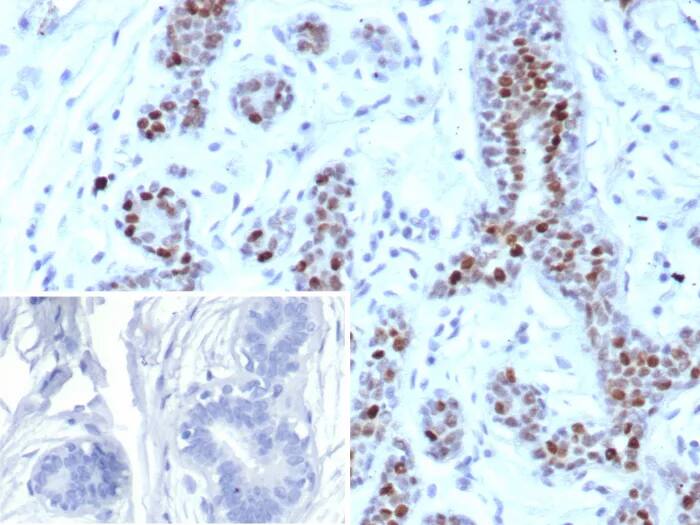 Immunohistochemistry-Paraffin: GATA-3 Antibody (rGATA3/9133) - Azide and BSA Free [NBP3-24310] - Formalin-fixed, paraffin-embedded human breast stained with GATA-3 Antibody (rGATA3/9133). Inset: PBS instead of primary antibody; secondary only negative control.