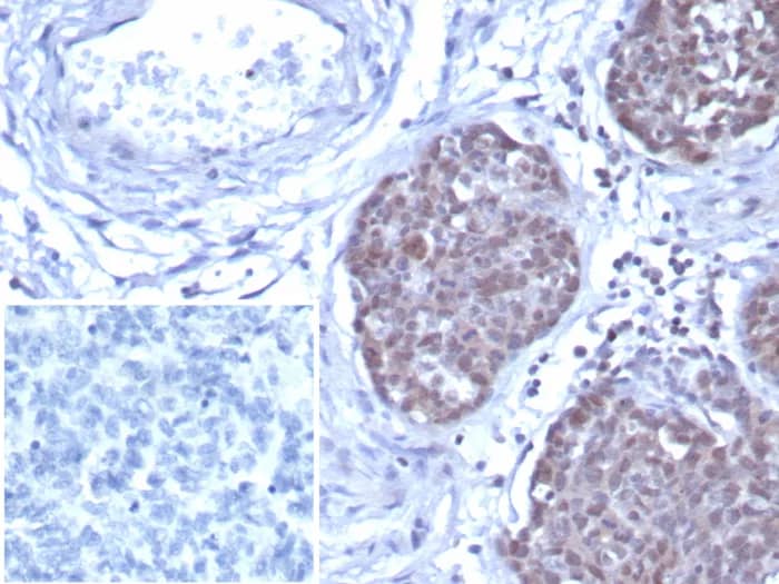 Immunohistochemistry-Paraffin: GATA-3 Antibody (GATA3/7686R) - Azide and BSA Free [NBP3-24311] - Formalin-fixed, paraffin-embedded human ovarian cancer stained with GATA-3 Antibody (GATA3/7686R). Inset: PBS instead of primary antibody; secondary only negative control.