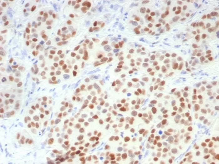 Immunohistochemistry-Paraffin: GATA-3 Antibody (GATA3/7686R) - Azide and BSA Free [NBP3-24311] - Formalin-fixed, paraffin-embedded human breast carcinoma stained with GATA-3 Antibody (GATA3/7686R). HIER: Tris/EDTA, pH9.0, 45min. 2°C: HRP-polymer, 30min. DAB, 5min.