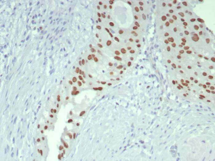 Immunohistochemistry-Paraffin: GATA-3 Antibody (GATA3/7686R) - Azide and BSA Free [NBP3-24311] - Formalin-fixed, paraffin-embedded human bladder stained with GATA-3 Antibody (GATA3/7686R). HIER: Tris/EDTA, pH9.0, 45min. 2°C: HRP-polymer, 30min. DAB, 5min.