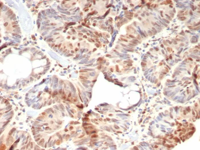 Immunohistochemistry-Paraffin: RB1 Antibody (rRB1/8060) - Azide and BSA Free [NBP3-24317] - Formalin-fixed, paraffin-embedded human colon carcinoma stained with RB1 Antibody (rRB1/8060). HIER: Tris/EDTA, pH9.0, 45min. 2°C: HRP-polymer, 30min. DAB, 5min.