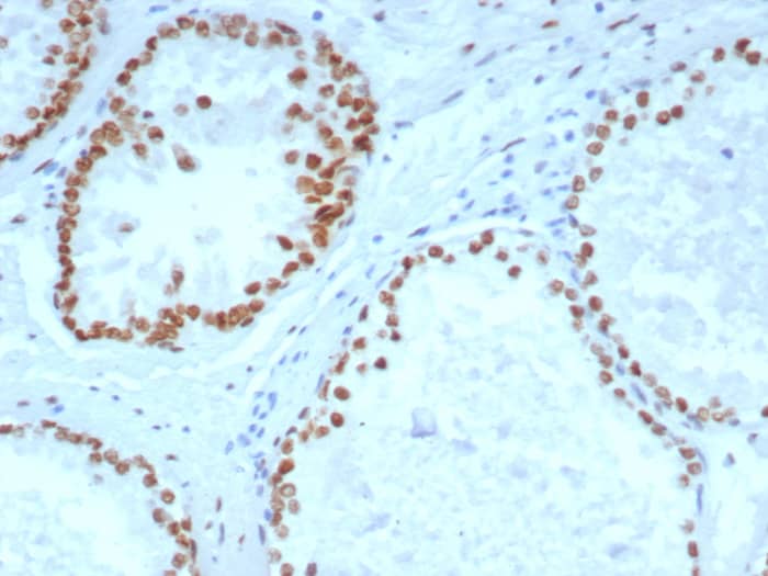 Formalin-fixed, paraffin-embedded human prostate carcinoma stained with Androgen R/NR3C4 antibody (DHTR/4929R) - Azide and BSA Free. HIER: Tris/EDTA, pH9.0, 95C/45min. Secondary Ab: HRP-Poly:30min. DAB:5min.