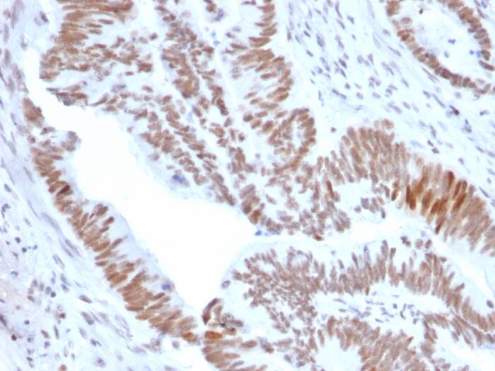Formalin-fixed, paraffin-embedded human colon tumor stained with DBC1/p30 antibody (PCRP-KIAA1967-1D10) - Azide and BSA Free. HIER: Tris/EDTA, pH9.0, 45min. Secondary: HRP-polymer, 30min. DAB, 5min.