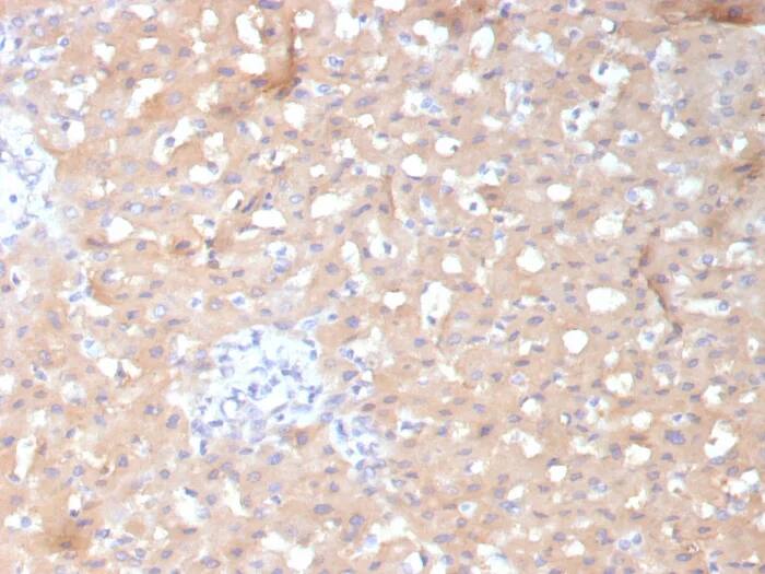 Immunohistochemistry-Paraffin: ALDH1L1 Antibody (ALDH1L1/7970) - Azide and BSA Free [NBP3-24335] - Formalin-fixed, paraffin-embedded human hepatocellular carcinoma stained with ALDH1L1 Antibody (ALDH1L1/7970). HIER: Tris/EDTA, pH9.0, 45min. 2°C: HRP-polymer, 30min. DAB, 5min.