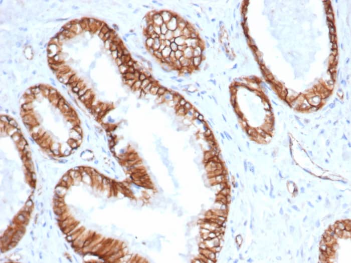 Formalin-fixed, paraffin-embedded human prostate carcinoma stained with beta-Catenin antibody (CTNNB1/6807R) - Azide and BSA Free. HIER: Tris/EDTA, pH9.0, 45min. Secondary: HRP-polymer, 30min. DAB, 5min.
