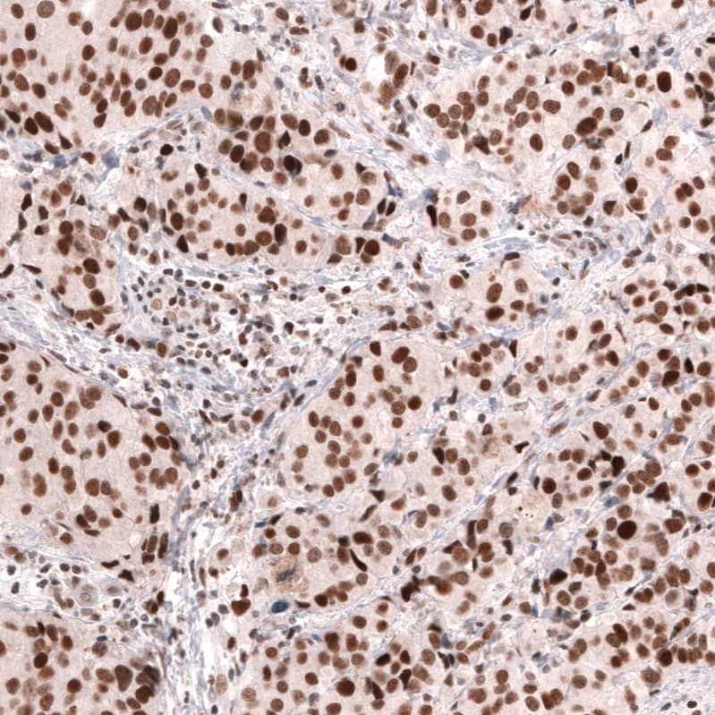 Staining of human breast cancer (ductal carcinoma) shows strong nuclear positivity in tumor cells.