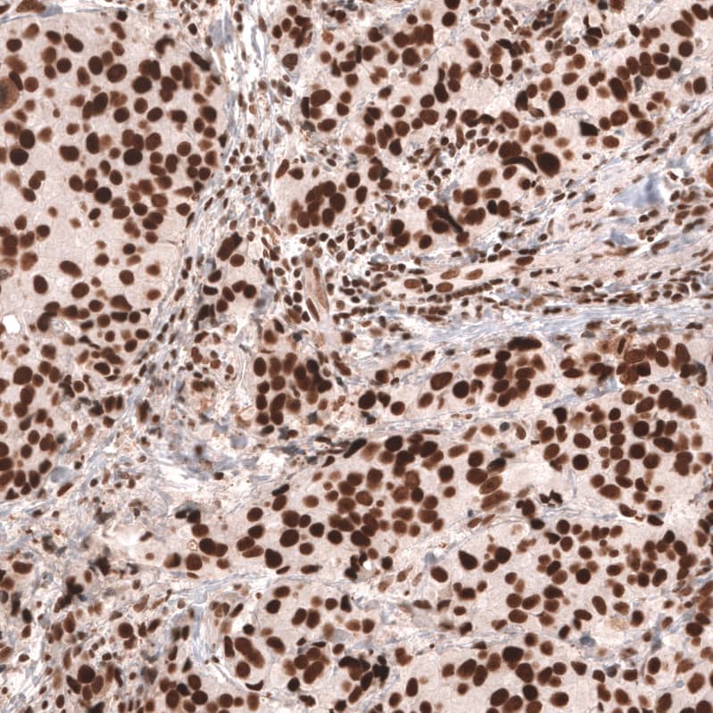 Staining of human breast cancer (ductal carcinoma) shows strong nuclear positivity in tumor cells.