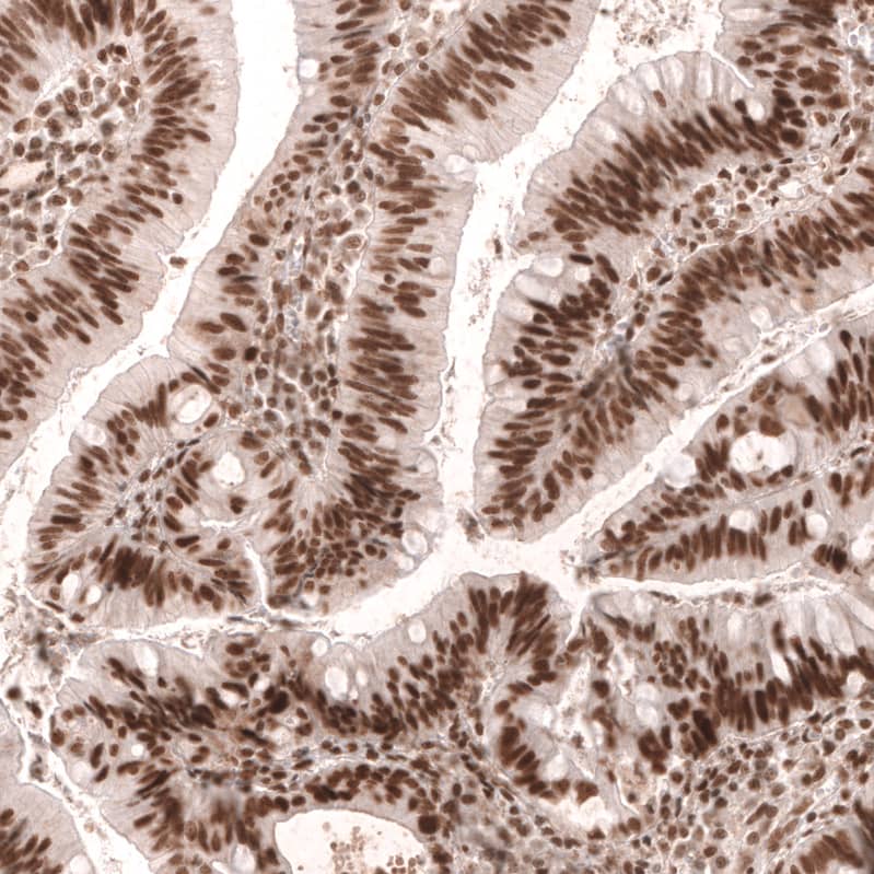 Staining of human colorectal cancer shows strong nuclear positivity in tumor cells.