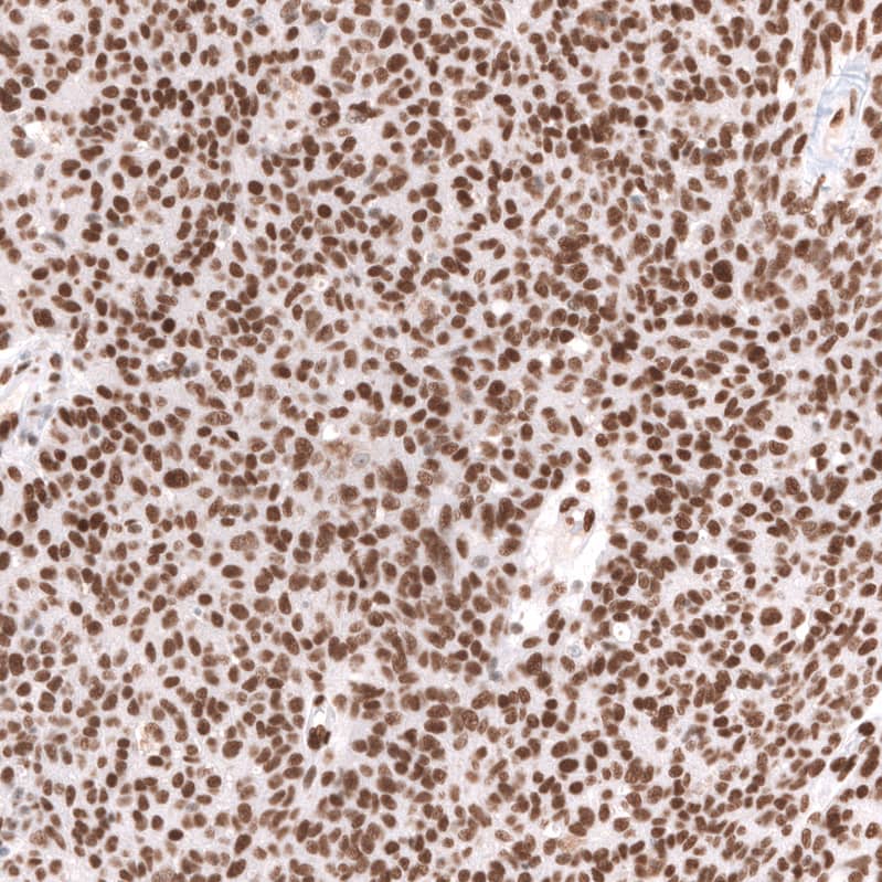 Staining of human ovarian cancer (high grade serous carcinoma) shows strong nuclear positivity in tumor cells.