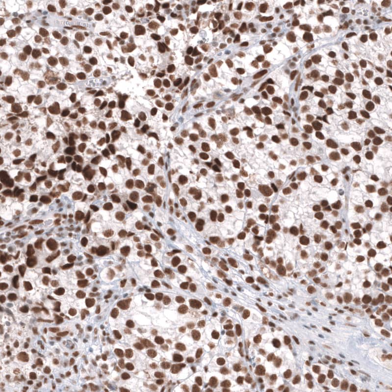 Staining of human testis cancer (seminoma) shows strong nuclear positivity in tumor cells.