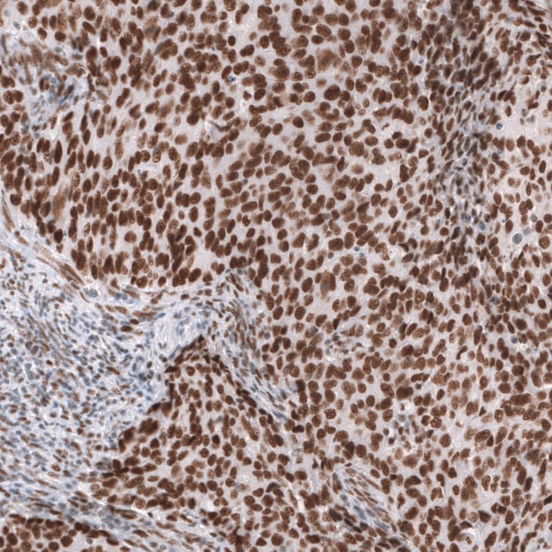 Staining of human endometrial cancer shows strong nuclear positivity in tumor cells.