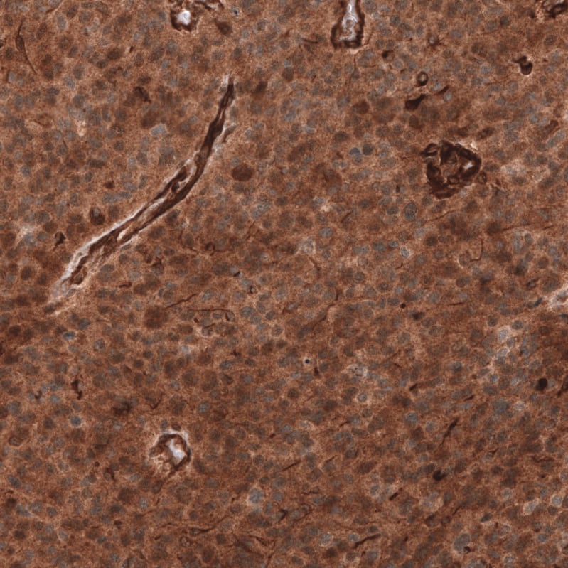 Staining of human anaplastic oligodendroglioma shows strong cytoplasmic positivity in tumor cells.