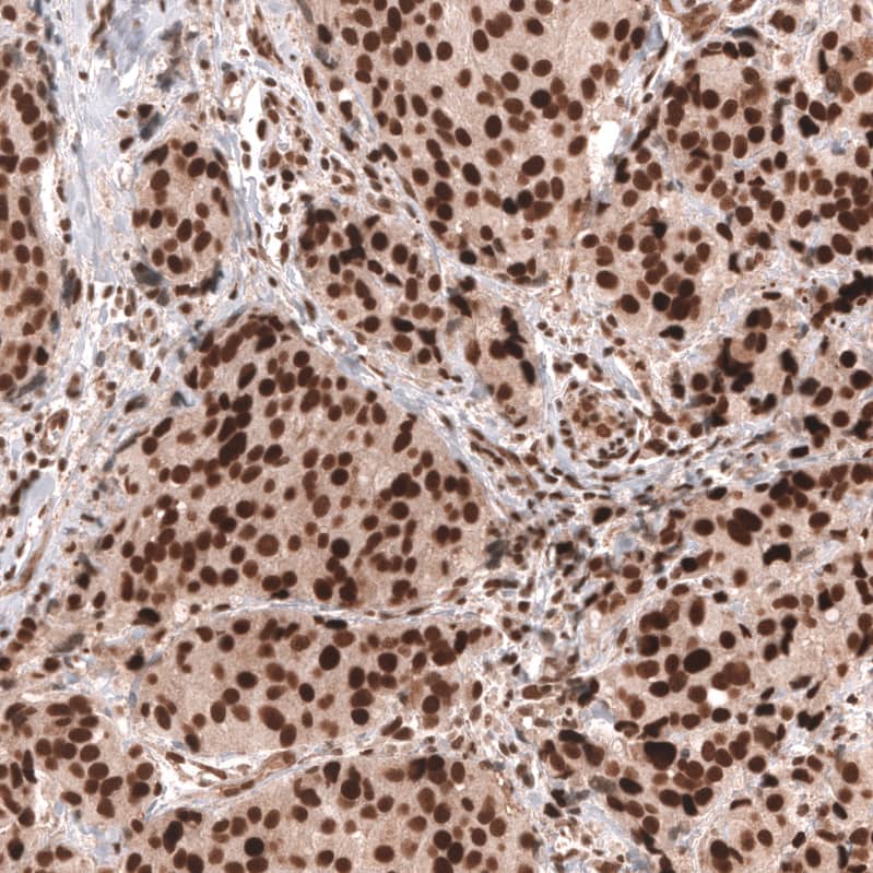 Staining of human breast cancer (ductal carcinoma) shows strong nuclear positivity in tumor cells.