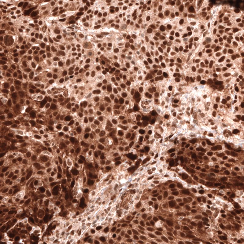 Staining of human cervical cancer shows strong nuclear positivity in tumor cells.