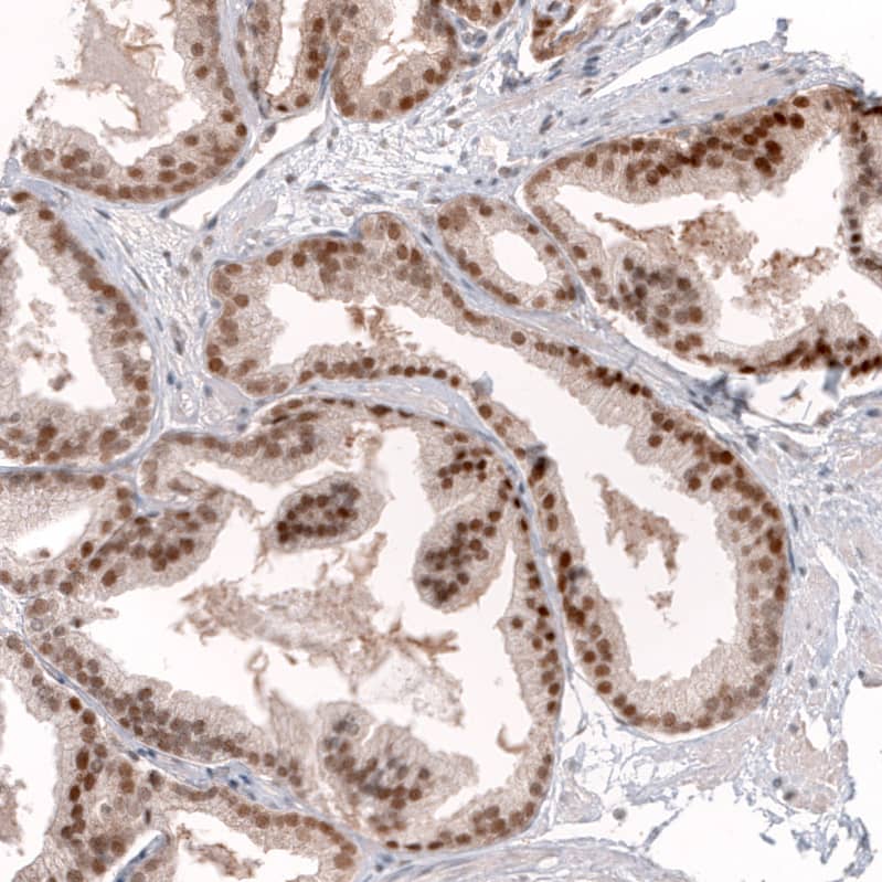 Staining of human prostate cancer shows moderate to strong nuclear positivity in tumor cells.