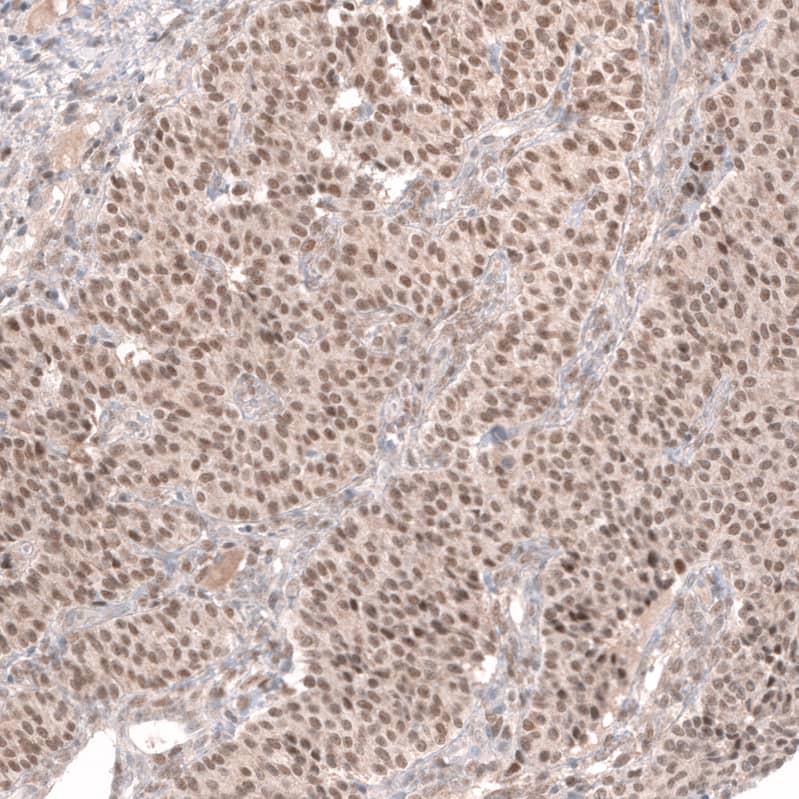 Staining of human ovarian cancer (sex cord tumor) shows moderate nuclear positivity in tumor cells.