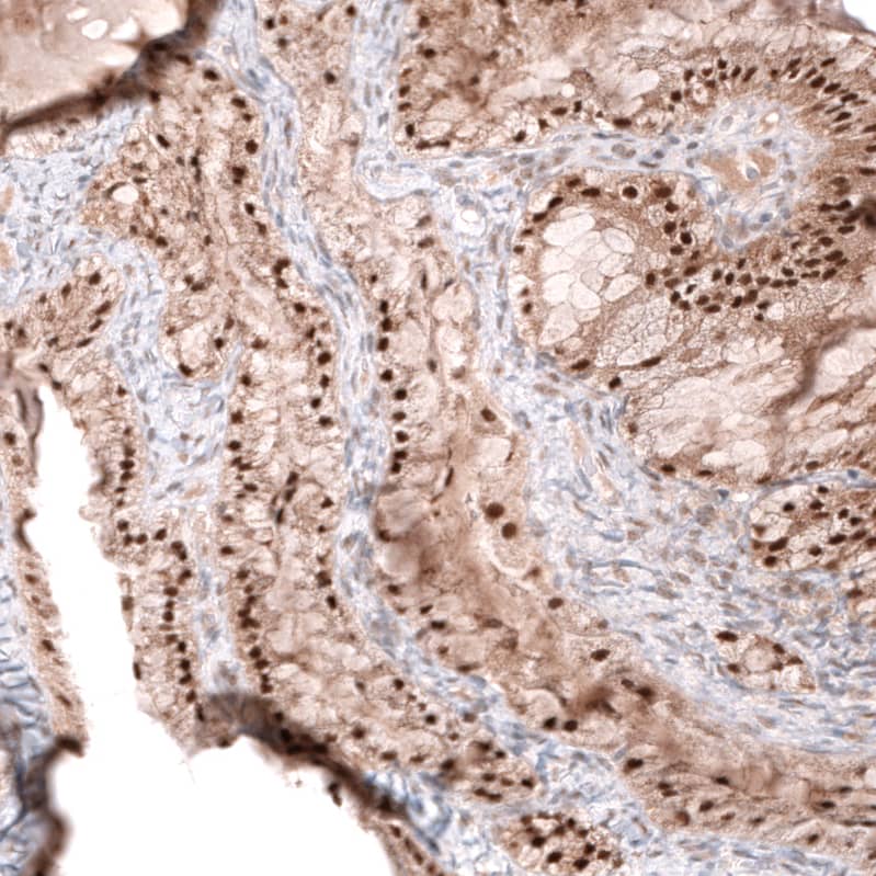 Staining of human ovarian cancer (mucinous) shows strong nuclear positivity in tumor cells.